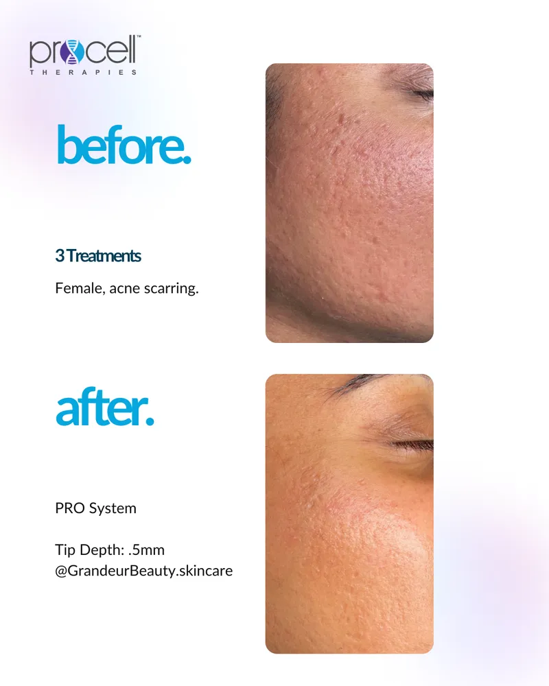 Acne Scars Treatment - Before and After