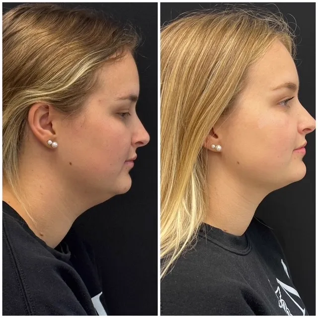 CoolSculpting Chin & Neck Result - Before and After