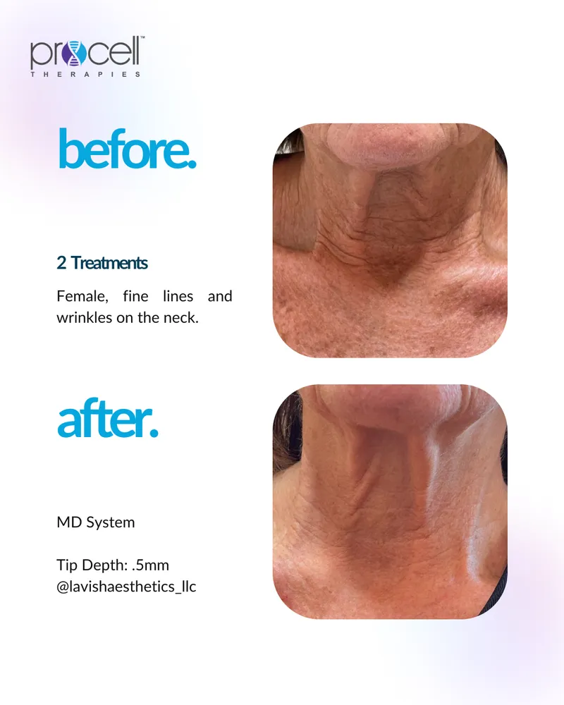 Fine Lines & Wrinkles Treatment - Before and After