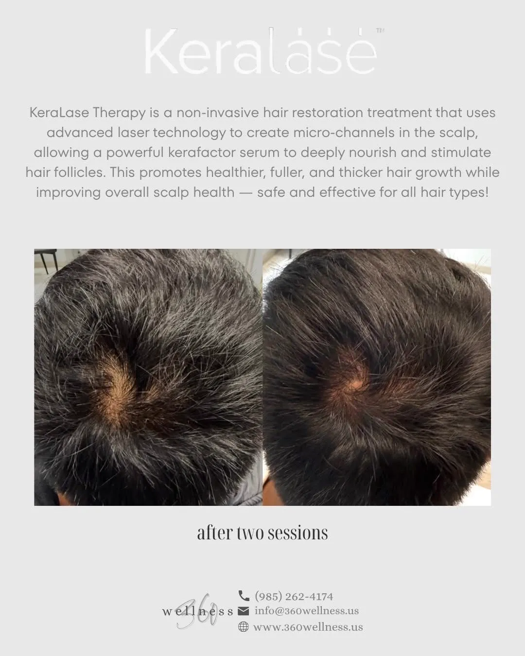 KeraLase Hair Restoration Result - Before and After