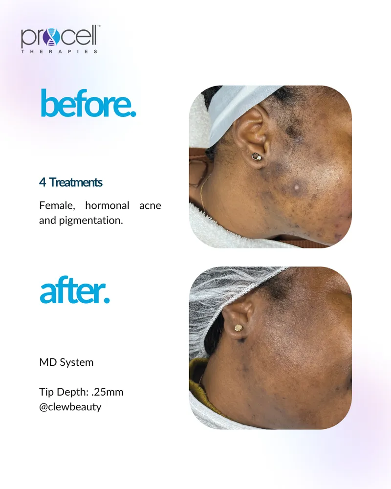 Hyperpigmentation Treatment - Before and After