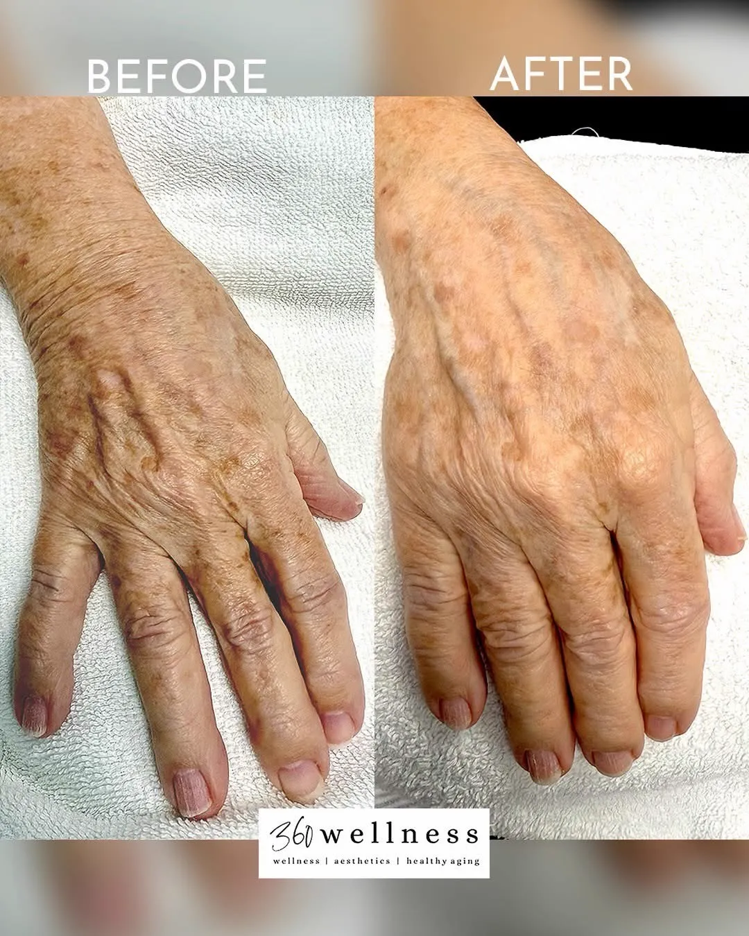 Laser Treatment for Age Spots on Hand - Before and After