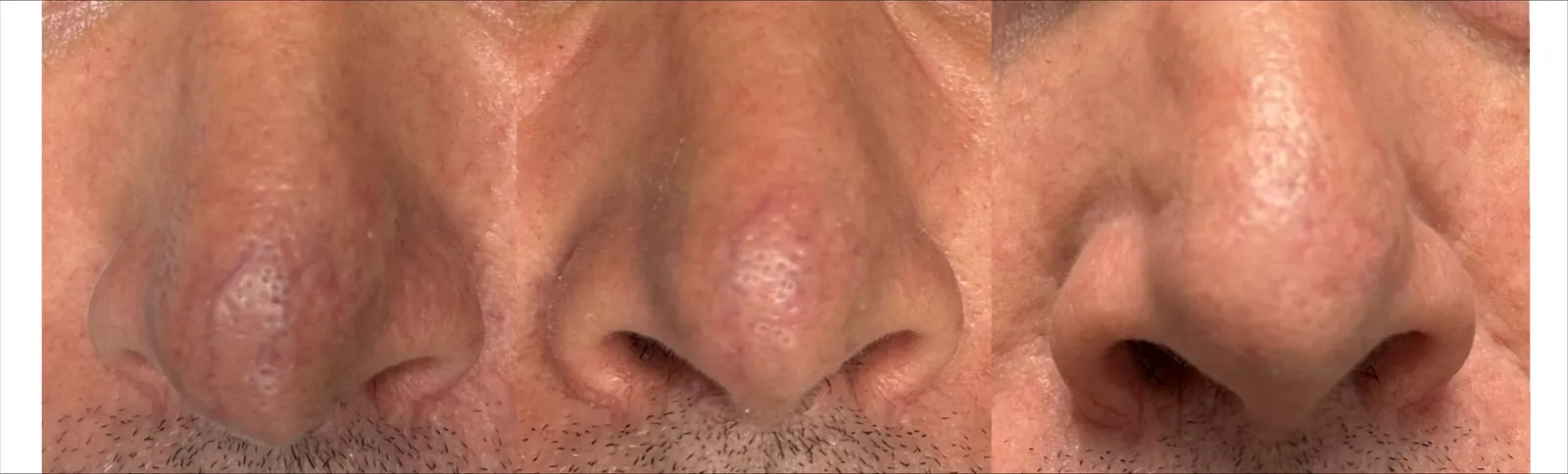 Skin Texture & Pore Refinement - Before and After