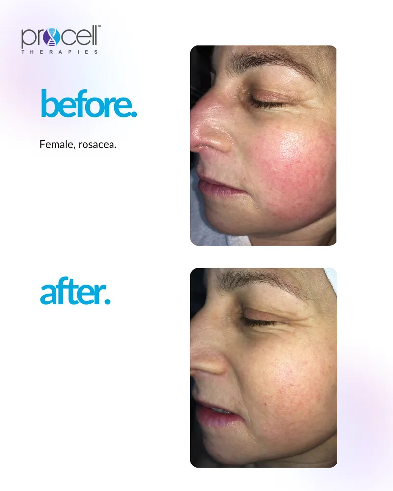 Rosacea Treatment - Before and After