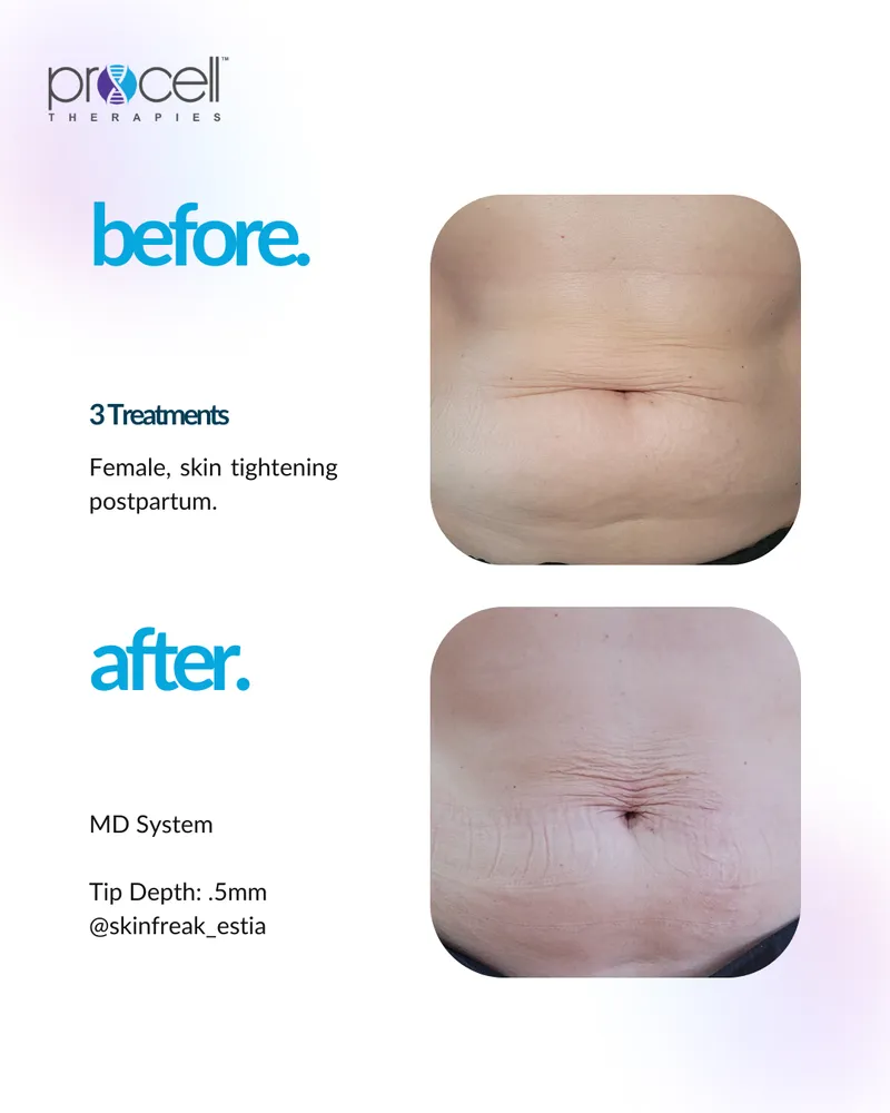 Skin Tightening Treatment - Before and After