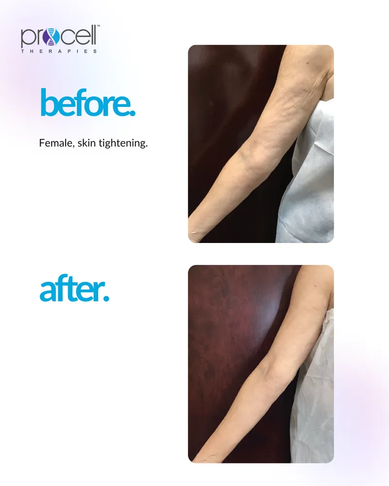 Skin Tightening Treatment - Before and After