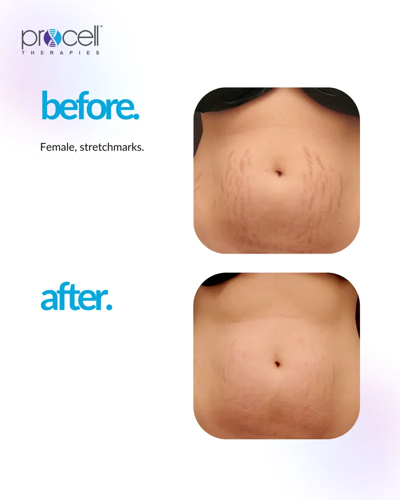 Stretch Marks Treatment - Before and After