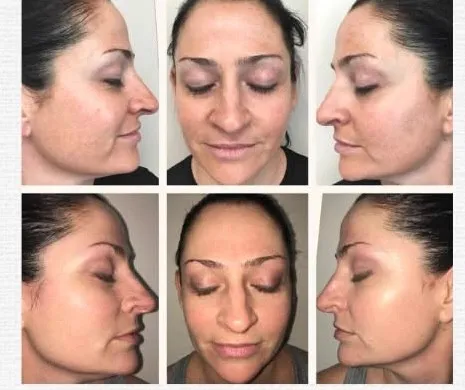 VI Chemical Peel Result - Before and After