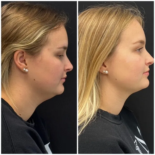 CoolSculpting Body Contouring